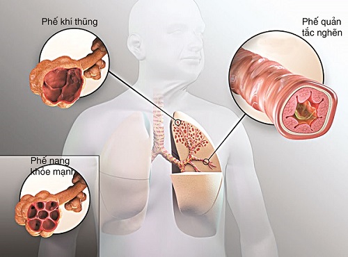 Viêm phổi nghiêm trọng đến mức nào?